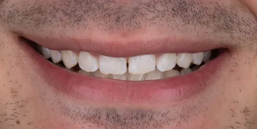 Antes - Diastema